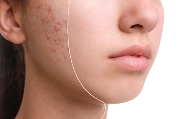 Acne Treatment in Amman: Combating Skin Concerns with Expert Care