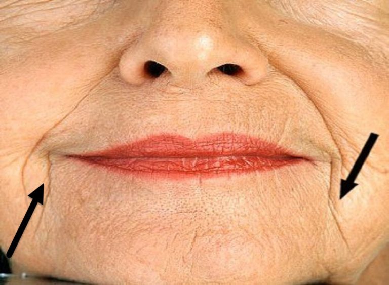What are the Different Types of Facial Lines?