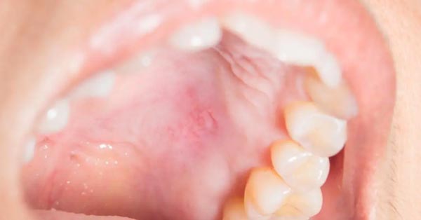 Why Does the Roof of My Mouth Hurt? Causes and Remedies